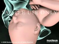Cesarean Birth (C-section)
