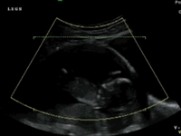 Blob - 13 weeks ultrasound