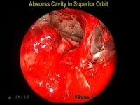 Endoscopic drainage of an epidural abscess