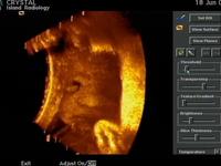 3D Ultrasound Highlights