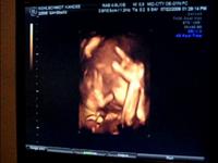 Baby Bean "Fuzzy Ramos" 3d/4d Ultrasound