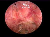 Postoperative endoscopic examination of the sinonasal space two years after treatment for esthesioneuroblastoma