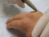 Pins being removed from my hand