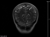 My Brain MRI, Front View