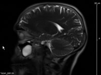 My Brain MRI, Side View 1