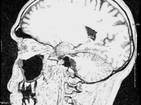 My Brain MRI, Side View 2
