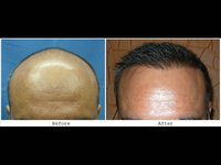 Bob's 5300 + FUSE grafts 5 month follow up