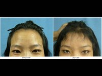 Jenny - 1562 FUSE grafts (6.5 month result)
