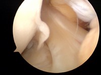 Arthrosopic surgery on my knee