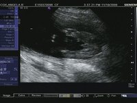 Ultrasound of Baby Cox