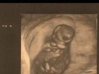 My Twin Pregnancy