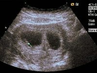 Ultrasound - It's Twins!!!