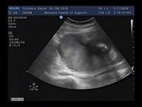 Sonogram 030209