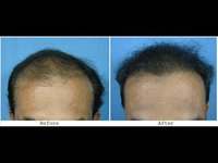 Veer - 6212 FUSE grafts (scalp, beard and chest hair used) - 11 month update