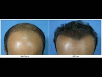 Venu - 3500 FUHT grafts (11 month update)