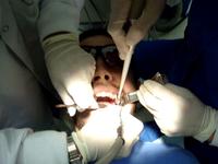tooth extraction