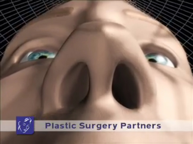 Rhinoplasty Burun Ameliyatı Animasyonu